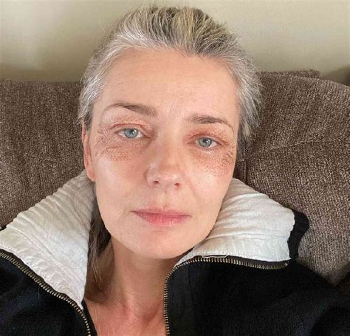 Paulina Porizkova, 55, Reveals Red & Blotchy Face After Plasma Pen Treatment: ‘Lookin’ Freaky’